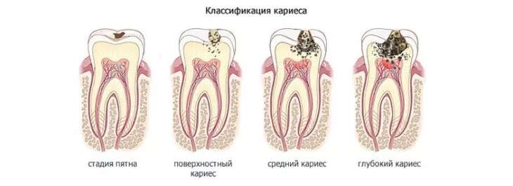 Кариес