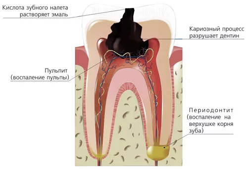 Периодонтит