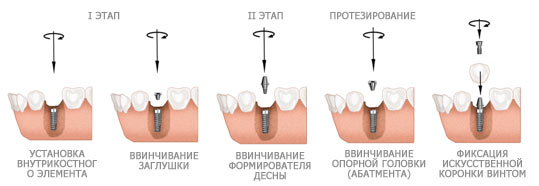 Имплантация зубов под ключ Имплантация зубов под ключ