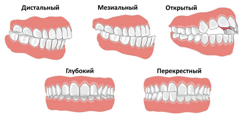 Неправильный прикус Неправильный прикус