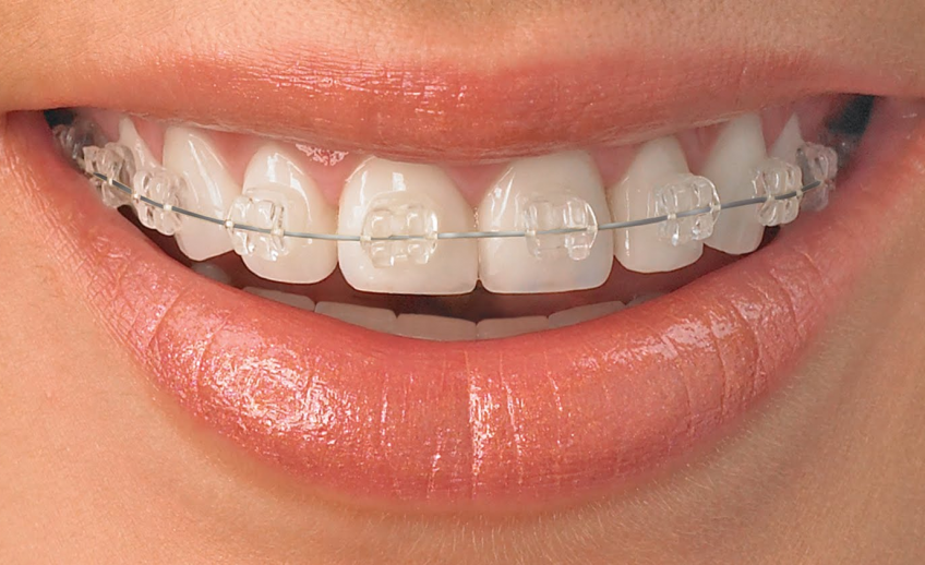Цена на установку брекетов из керамики и сапфира