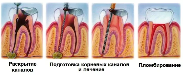Периодонтит